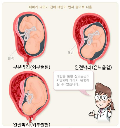 태반조기박리의 유형 - 부분박리(외부출혈), 완전박리(은닉출혈), 완전박리(외부출혈)