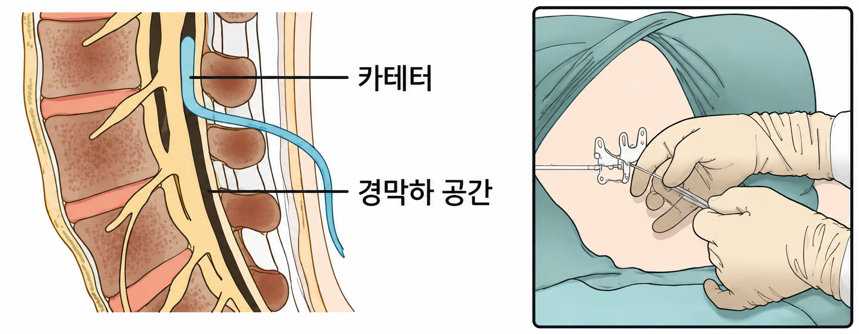 무통 시술 위치 - 요추 사이 경막하 공간에 카테터를 넣는 그림
